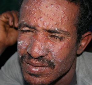 Кала-азар (черная болезнь) - кожа поражается паразитами лейшманиями (кожный лейшманиоз)